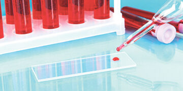 Изобретён тест для диагностики болезни Паркинсона по крови